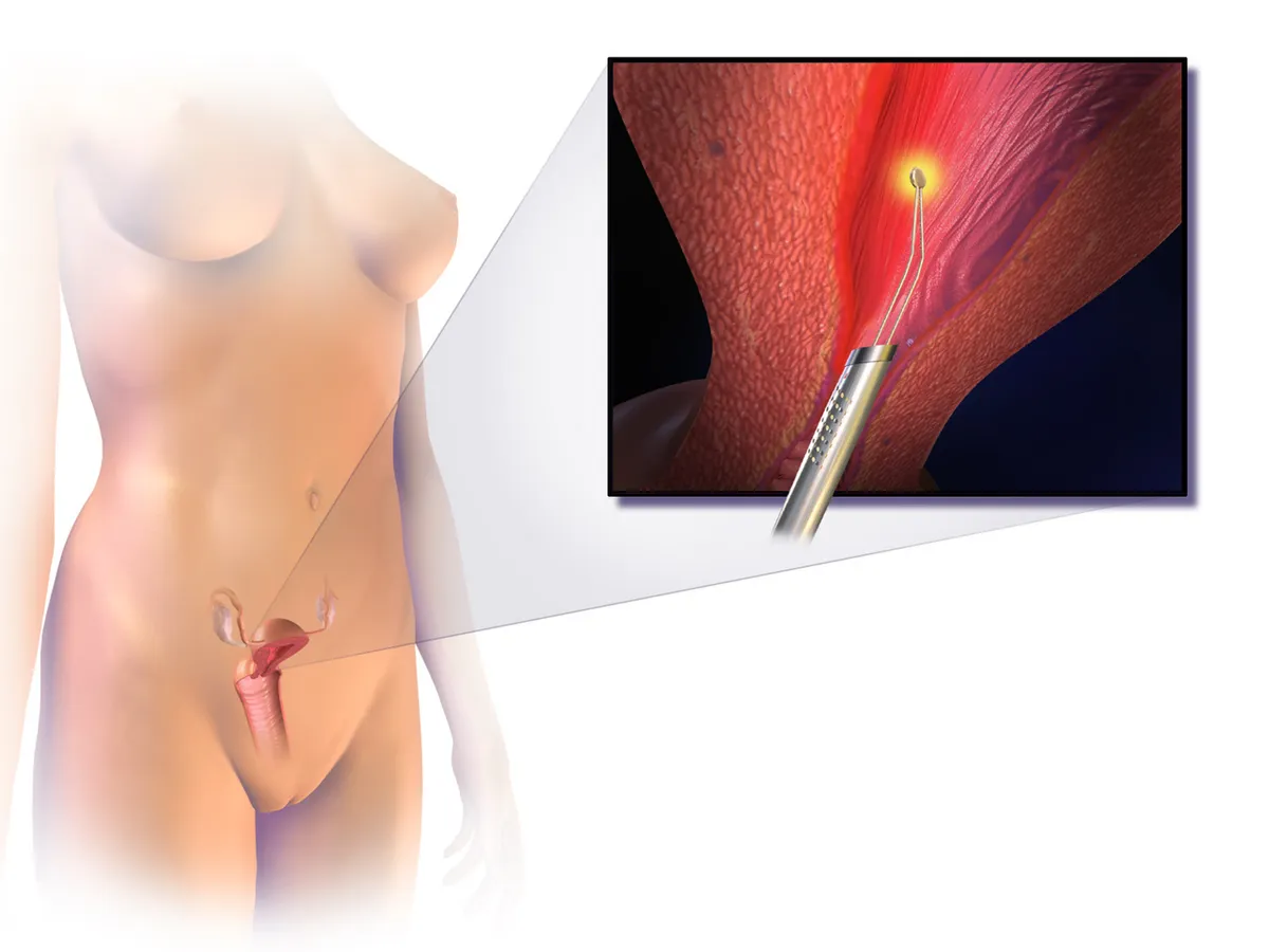 Illustration of an endometrial ablation procedure