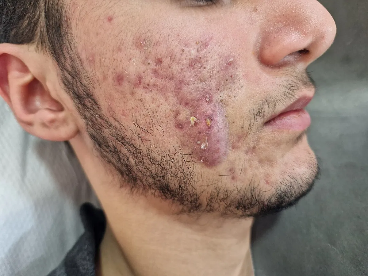 Cheek and jaw of a young man with nodular and cystic acne: deep, red, swollen lesions