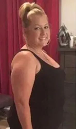Brandy before revision to gastric bypass