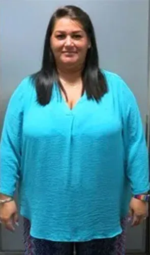 Dania before gastric sleeve