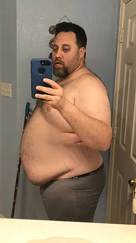 Jacob before gastric sleeve