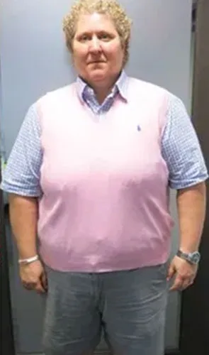 Shan before gastric sleeve