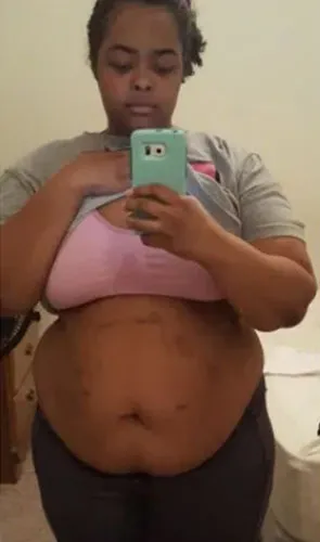 Tay before gastric sleeve