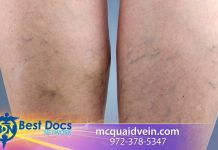 Dr. McQuaid Risks of Not Treating Vein Problems
