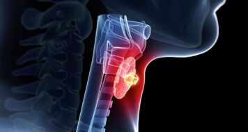 Strep Throat vs. Viral Sore Throat: How to Tell the Difference